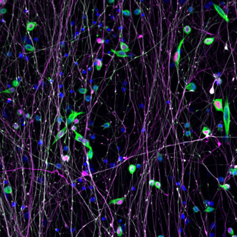 Breast Cancer Cells in Co-Culture with Neurons by Rachel Davis