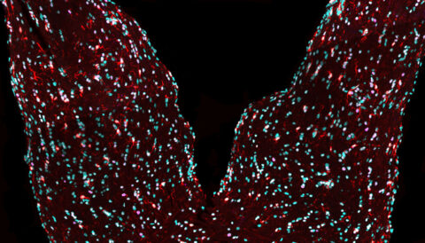 Microglia (red) populate the proximal optic nerves of a mouse with optic pathway glioma. The putative tumor-bearing region (right) shows disrupted cellular organization, where irregularly positioned oligodendrocytes (pink) trace the altered architecture of the optic nerve.