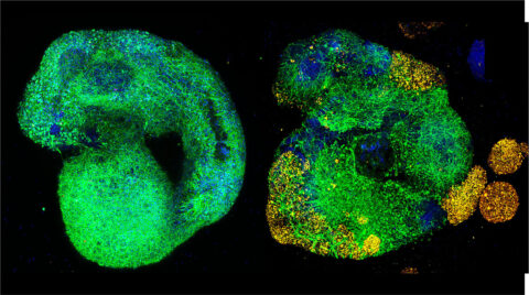 On the left, a healthy brain organoid self-organizes into complex neuronal networks. On the right, the same system is invaded by glioblastoma multiforme (yellow), the deadliest brain cancer. Cancer cells integrate into neural circuits, exposing how malignancy hijacks human brain tissue and reshapes its delicate architecture.