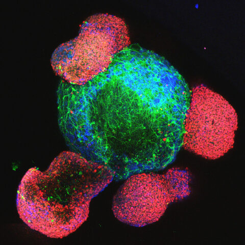 A human brain organoid (green/blue) surrounded by glioblastoma multiforme cell clusters (red). The cancer integrates into neural networks, showing how malignant cells infiltrate and rewire healthy brain tissue. This striking image captures the clash between organized neural architecture and the chaos of the most aggressive brain cancer.