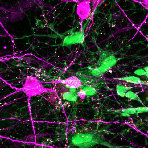 A confocal microscopy image showing human neurons (magenta) forming connections with diffuse midline glioma cells (green), a rare childhood brain cancer. The red and white dots mark synapses — tiny contact points where the cells communicate. These signals show how tumor cells interact with and respond to nearby neurons.