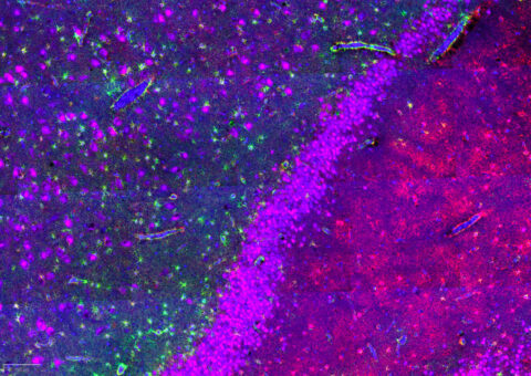 Detailed view of the dentate gyrus of the hippocampus of an Alzheimer’s disease patient. Astrocytes were stained with ALDH1L1 (red) and GFAP (green). Neurons were stained with NeuN (magenta). All nuclei were stained with DAPI (blue).