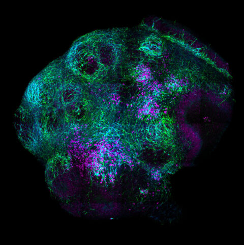 A motoneuron-containing midbrain organoid derived from human induced pluripotent stem cells (reprogrammed from skin tissue), cultured in vitro for 55 days. The magenta staining (Islet1) reveals the organized nuclei of motoneurons, the blue staining (ChAT) marks cholinergic neurons, and the green staining (MAP2) specifically labels neuronal microtubules.
