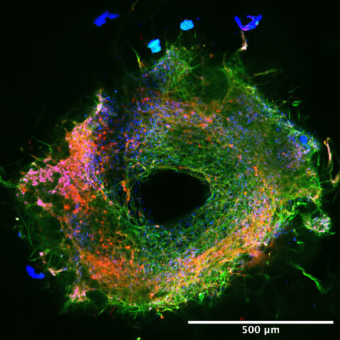 Patient-Derived Midbrain Organoid to Study Parkinson's Disease by Ewa Grassin
