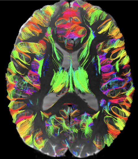 Mapping of Superficial White Matter Connections: by Fan zhang