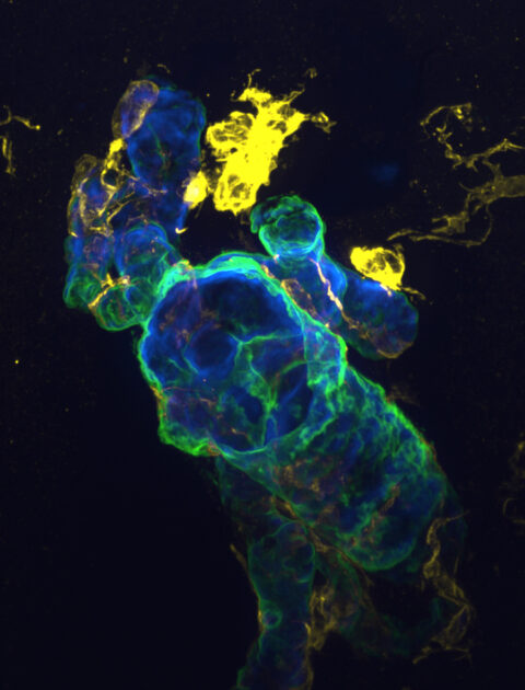 Anti-Amyloid Antibody Binding to Vascular Amyloid with Microglia Recruitment by Praveen Bathini.