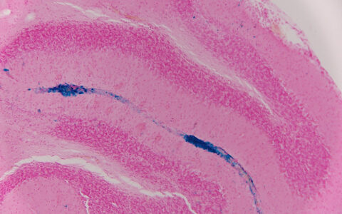 Anti-Amyloid Antibody Binding to Vascular Amyloid with Microglia Recruitment by Praveen Bathini