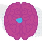 illustration of a brain with a tumor.