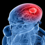 Glioblastoma image