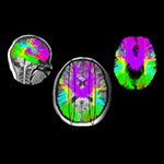 A study at Boston Children’s finds that moyamoya’s severity isn’t always tied to symptoms. Advanced imaging such as dMRI reveals hidden white matter damage in asymptomatic children.