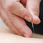 A close up of a hand applying an acupuncture needle.