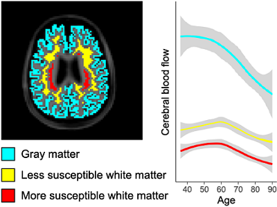 MRI image of the brain and graph