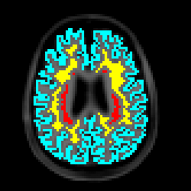 MRI image of the brain