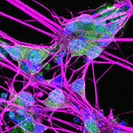Disabling SARM1 protects retinal ganglion cells from degeneration in OPA1-related optic atrophy.