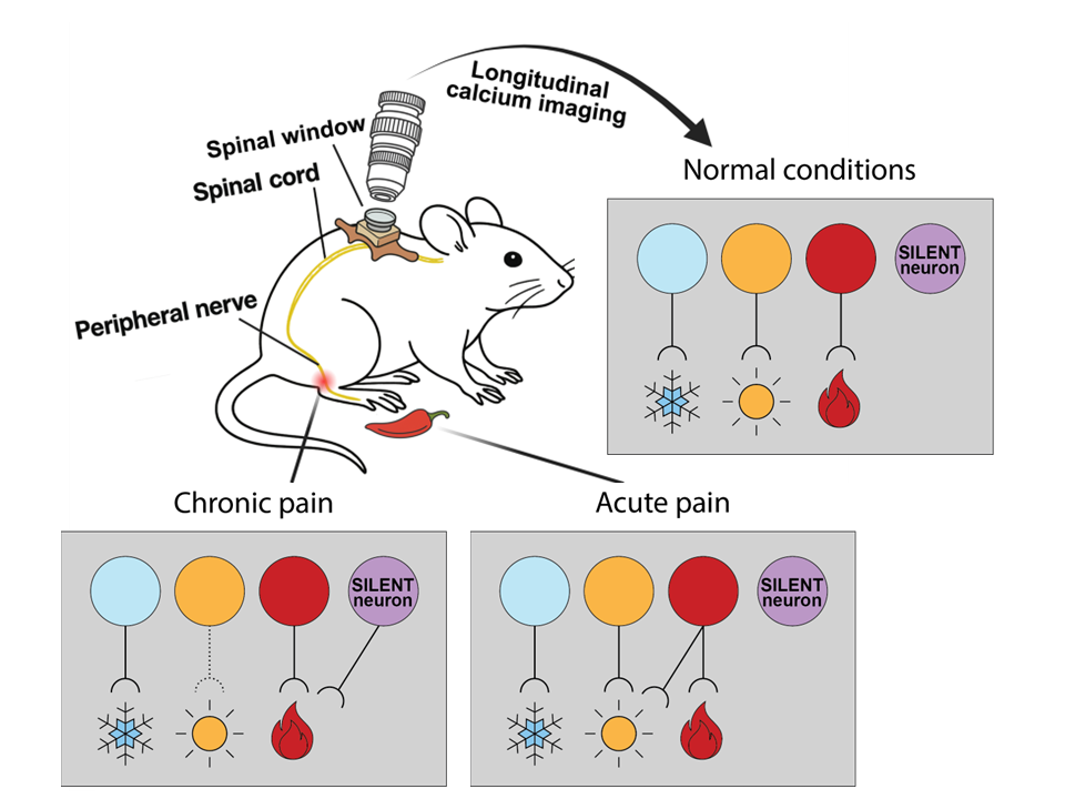 •Normal conditions: Distinct spinal neuron groups carry signals for cold, warmth, and painful heat. • Acute pain (capsaicin): Pain neurons become temporarily more sensitive, responding to low-level warm stimuli but then return to their high-threshold state soon after. • Chronic pain (peripheral nerve injury): Responses to gentle warmth are diminished, while previously silent neurons (purple) become persistently active in response to high-intensity signals. 