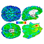 Left: Tau PET images for a person with normal cognition. Right: top, 3D brain surface rendering with tau PET overlay; bottom, flat map showing brain surface details, with cortical tau origin (rhinal cortex) outlined in white.