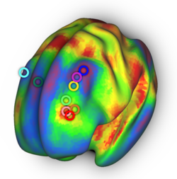 The “targeting atlas” derived in Siddiqi et al.’s recent study