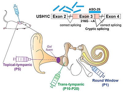 Illustration of antisense oligonucleotides (ASO-29) treatment being applied to three different parts of the ear. The Round Window injection was most effective and resulted in unprecedented recovery of auditory and vestibular function.