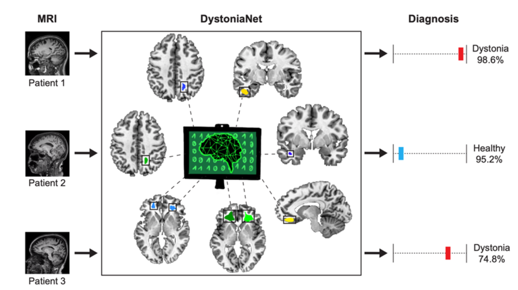 DystoniaNet receives a raw MRI as input, and uses its data-driven biomarker to make a probabilistic diagnosis of dystonia for each patient.
