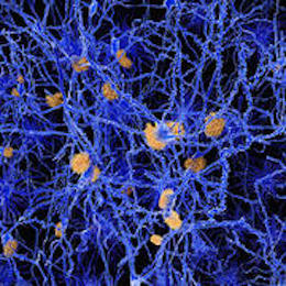 alzheimers thumbnail