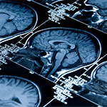 alzheimers
