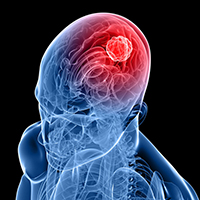 A 3-D image of a human skull and brain depicting cancer