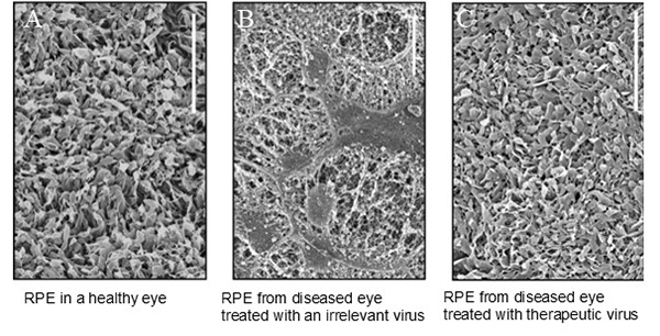 Gene Therapy Can Preserve the Retinal Pigment Epithelium in Retinitis Pigmentosa