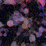 Researchers analyzed tumor samples from patients to determine what genes turned on or off within the position of the tumor using spatial transcriptomics. (Image courtesy of The Filbin Lab, Boston Children's Hospital.)