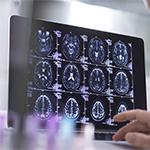 photo of human brain scans on a computer screen