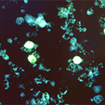 Cells infected with Epstein-Barr, a common herpes virus that can cause mononucleosis and establishes a latent, lifelong infection of the host.
