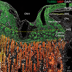 The part of the optic nerve that traverses the eyeball is called the optic nerve head. Defects in this specialized region play a key role in the pathogenesis of glaucoma. This section was stained with an antibody to a protein called myelin basic protein (orange), which is present in the optic nerve proper but not the optic nerve head. The axons that run from the retina to the rest of the brain are stained with an antibody to tubulin (green).