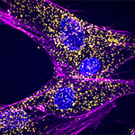Microscopy image indicating a plethora of abnormal RNAs in fibroblast cells from a patient with an Integrator mutation
