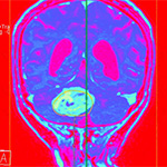 MRI scan of a brain with a glioblastoma