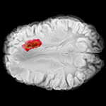 lustration of a glioblastoma.
