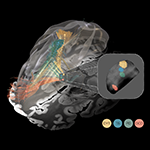 Unveiling the spectrum of the ‘dysfunctome’ through the prism of deep brain stimulation. Deep brain stimulation functions akin to a prism fragmenting the light, in that it segregates the connectome into dysfunctional circuits whose stimulation was associated with symptom improvement in Parkinson’s disease (PD), dystonia (DYT), Tourette’s syndrome (TS), and obsessive-compulsive disorder (OCD). Mappings are superimposed onto a 100 μm ex-vivo brain template for anatomical reference (Edlow et al. 2019). Inset: Optimal stimulation sites within the same small subcortical nucleus — the subthalamic nucleus — for all four disorders.