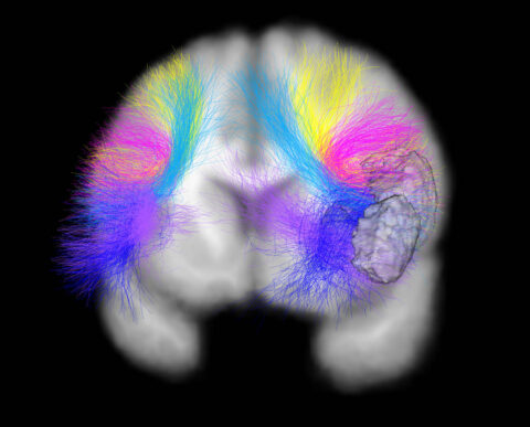 Superficial White Matter Connections to Broca’s Language Area by Shiva Hassanzadeh-Behbahni