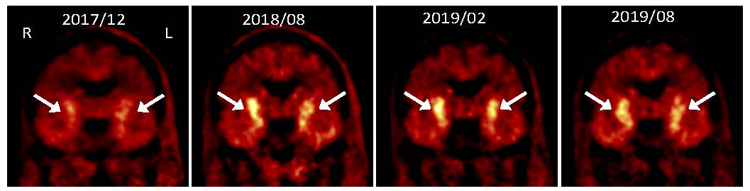 PET images showing progressive increase in uptake of dopamine precursor 18F-DOPA following grafting of dopaminergic neurons made from autologous induced pluripotent stem cells