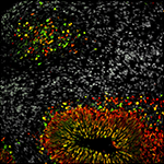 A brain organoid grown from induced pluripotent stem cells derived from patients suffering from bipolar disorder (BD).
