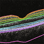 Optical coherence tomography shows thickness of nine retinal layers across all individuals studied.