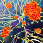 Neurons in Alzheimer's disease. 3D illustration