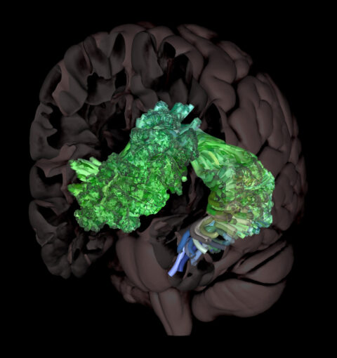 A Reconstructed Arcuate Fasciculus by Steven Meisler